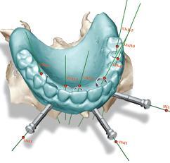 teeth-in-an-hour dental implants
